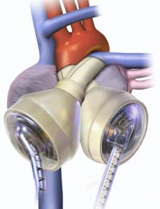 Syncardia heart